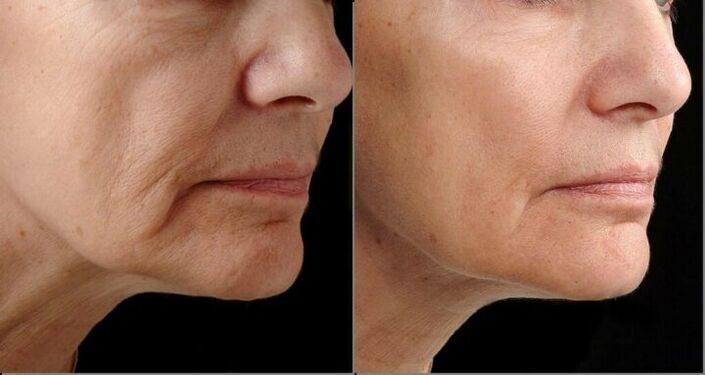 Peau du visage avant et après la procédure de rajeunissement au laser