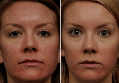 avant et après rajeunissement fractionné de la peau photo 6